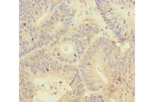 Immunohistochemistry of paraffin-embedded human colon cancer using ABIN7145011 at dilution of 1:100