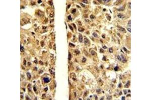 IHC analysis of FFPE human hepatocarcinoma stained with ARG1 antibody (Liver Arginase antibody  (AA 293-322))
