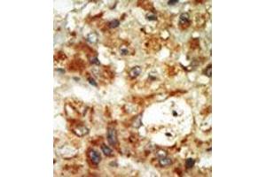 Formalin-fixed and paraffin-embedded human cancer tissue (hepatocarcinoma) reacted with the primary antibody, which was peroxidase-conjugated to the secondary antibody, followed by AEC staining. (MAPK12 antibody  (Middle Region))