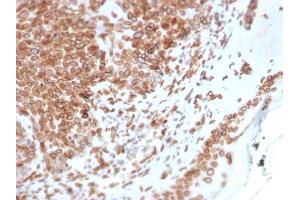 Formalin-fixed, paraffin-embedded human Basal Cell Carcinoma stained with Emerin Mouse Monoclonal Antibody (EMD/2168). (Emerin antibody  (AA 56-167))