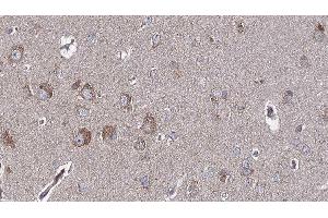 ABIN6276758 at 1/100 staining Human brain cancer tissue by IHC-P. (Dihydrofolate Reductase antibody)