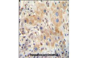 NR0B2 antibody immunohistochemistry analysis in formalin fixed and paraffin embedded human hepatocarcinoma followed by peroxidase conjugation of the secondary antibody and DAB staining.