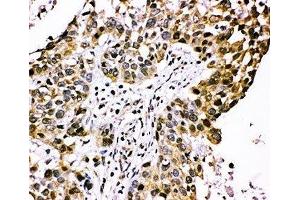 IHC-P: CISH antibody testing of human lung cancer tissue (CISH antibody  (AA 241-258))