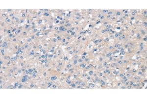 Immunohistochemistry of paraffin-embedded Human liver cancer using SNX3 Polyclonal Antibody at dilution of 1:30 (Sorting Nexin 3 antibody)