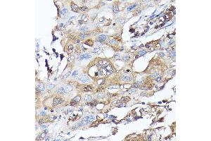 Immunohistochemistry of paraffin-embedded human lung cancer using MLST8 Rabbit pAb (ABIN6131371, ABIN6143894, ABIN6143895 and ABIN6217660) at dilution of 1:100 (40x lens).