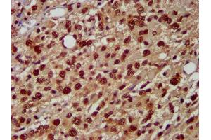 IHC image of ABIN7155093 diluted at 1:500 and staining in paraffin-embedded human glioma performed on a Leica BondTM system. (HNRNPAB antibody  (AA 1-68))