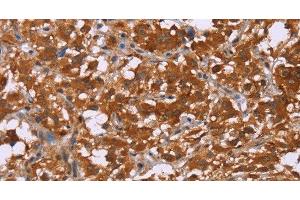 Immunohistochemistry of paraffin-embedded Human thyroid cancer tissue using DCBLD2 Polyclonal Antibody at dilution 1:50 (DCBLD2 antibody)