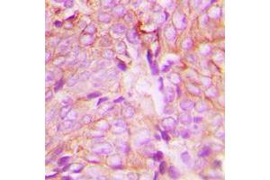 Immunohistochemical analysis of PKC delta (pY313) staining in human breast cancer formalin fixed paraffin embedded tissue section.