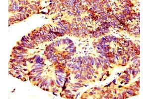 IHC image of ABIN7168252 diluted at 1:300 and staining in paraffin-embedded human ovarian cancer performed on a Leica BondTM system. (RNF219 antibody  (AA 257-465))