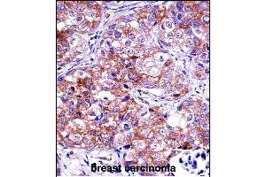 IDH1 Antibody (C-term) ((ABIN657472 and ABIN2846500))immunohistochemistry analysis in formalin fixed and paraffin embedded human breast carcinoma followed by peroxidase conjugation of the secondary antibody and DAB staining. (IMPDH1 antibody  (C-Term))