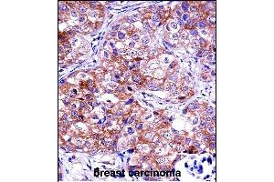 IDH1 Antibody (C-term) ((ABIN657472 and ABIN2846500))immunohistochemistry analysis in formalin fixed and paraffin embedded human breast carcinoma followed by peroxidase conjugation of the secondary antibody and DAB staining. (IMPDH1 antibody  (C-Term))