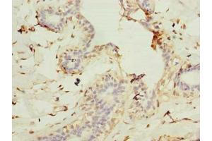 Immunohistochemistry of paraffin-embedded human breast cancer using ABIN7147425 at dilution of 1:100 (Cep76 antibody  (AA 241-550))