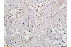Formalin-fixed and paraffin embedded human gastric cancer labeled with Anti-HIF-1? (Histone H1.5 antibody  (AA 681-789))