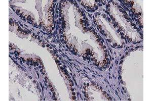 Immunohistochemical staining of paraffin-embedded Carcinoma of Human kidney tissue using anti-NT5DC1 mouse monoclonal antibody. (NT5DC1 antibody)