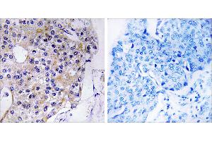 Peptide - +Immunohistochemistry analysis of paraffin-embedded human breast carcinoma tissue using CEP110 antibody.