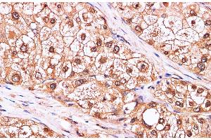 Immunohistochemistry of paraffin-embedded Human liver cancer using CDK4 Polyclonal Antibody at dilution of 1:100 (CDK4 antibody)