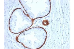 Formalin-fixed, paraffin-embedded human Prostate Carcinoma stained with Cytokeratin 14 Mouse Monoclonal Antibody (KRT14/2375). (KRT14 antibody  (AA 351-472))