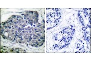 Immunohistochemistry analysis of paraffin-embedded human breast carcinoma, using Acetyl-CoA Carboxylase (Phospho-Ser80) Antibody. (Acetyl-CoA Carboxylase antibody  (pSer80))