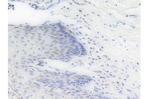 Phospho-PHB2 (Ser39) Antibody at 1/100 staining human cervical carcinoma by IHC-P.