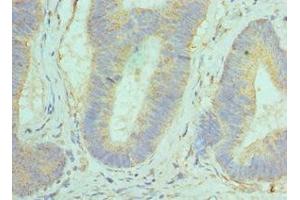 Immunohistochemistry of paraffin-embedded human colon cancer using ABIN7154290 at dilution of 1:100 (GOLM1 antibody  (AA 112-401))