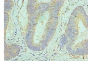 Immunohistochemistry of paraffin-embedded human colon cancer using ABIN7154290 at dilution of 1:100