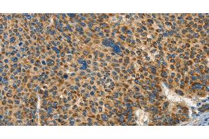 Immunohistochemistry of paraffin-embedded Human liver cancer tissue using IFT74 Polyclonal Antibody at dilution 1:60 (IFT74 antibody)