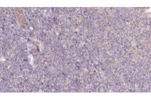 ABIN6273059 at 1/100 staining Human lymph cancer tissue by IHC-P. (NAPRT1 antibody  (Internal Region))