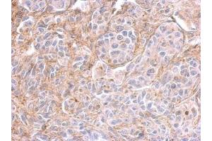 IHC-P Image PPFIBP2 antibody detects PPFIBP2 protein at on SkHep1 xenograft by immunohistochemical analysis. (PPFIBP2 antibody  (Center))