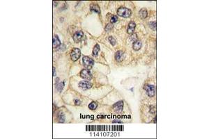 Formalin-fixed and paraffin-embedded human lung carcinoma tissue reacted with CD14 antibody (C-term), which was peroxidase-conjugated to the secondary antibody, followed by DAB staining. (CD14 antibody  (C-Term))