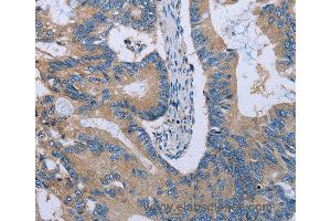 Immunohistochemistry of Human colon cancer using HYAL3 Polyclonal Antibody at dilution of 1:40 (HYAL3 antibody)