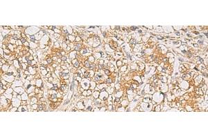 Immunohistochemistry of paraffin-embedded Human liver cancer tissue using PTPRN Polyclonal Antibody at dilution of 1:55(x200) (PTPRN antibody)