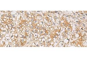 Immunohistochemistry of paraffin-embedded Human liver cancer tissue using PTPRN Polyclonal Antibody at dilution of 1:55(x200)