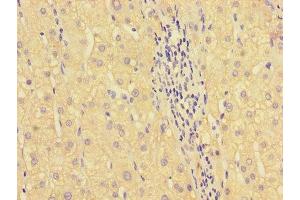 Immunohistochemistry of paraffin-embedded human liver cancer using ABIN7155713 at dilution of 1:100 (HOXA2 antibody  (AA 26-124))