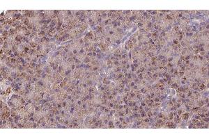 ABIN6273252 at 1/100 staining Human pancreas cancer tissue by IHC-P. (GSTM3 antibody  (C-Term))