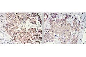 Immunohistochemical analysis of paraffin-embedded galactophore tumour using ERBB2 mouse mAb with DAB staining (ErbB2/Her2 antibody  (AA 750-987))