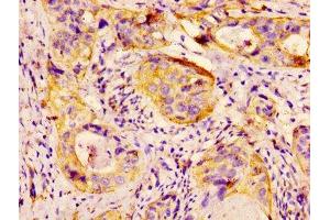 IHC image of ABIN7154907 diluted at 1:300 and staining in paraffin-embedded human cervical cancer performed on a Leica BondTM system.