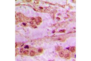 Immunohistochemical analysis of API5 staining in human lung cancer formalin fixed paraffin embedded tissue section.