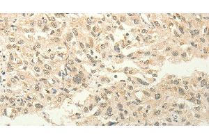 Immunohistochemistry of paraffin-embedded Human esophagus cancer tissue using FZD8 Polyclonal Antibody at dilution 1:50 (FZD8 antibody)