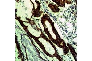 Immunohistochemical analysis of COX4-1 staining in human colon cancer formalin fixed paraffin embedded tissue section. (COX IV antibody)