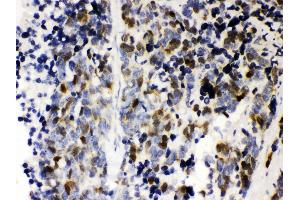 Anti- Cyclin A2 Picoband antibody, IHC(P) IHC(P): Human Lung Cancer Tissue (Cyclin A antibody  (AA 10-168))