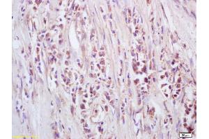 Formalin-fixed and paraffin embedded human lung carcinoma labeled with Anti-GTSE-1 Polyclonal Antibody, Unconjugated (ABIN741405) at 1:200, followed by conjugation to the secondary antibody and DAB staining