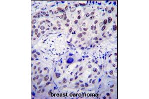 USF1 Antibody (Center) (ABIN655030 and ABIN2844661) immunohistochemistry analysis in formalin fixed and paraffin embedded human breast carcinoma followed by peroxidase conjugation of the secondary antibody and DAB staining. (USF1 antibody  (AA 174-201))