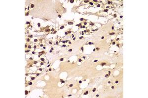 Immunohistochemistry of paraffin-embedded human kidney cancer using ZNF20 antibody  at dilution of 1:100 (40x lens). (ZNF20 antibody  (AA 1-200))