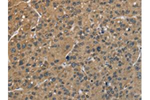 The image is immunohistochemistry of paraffin-embedded Human liver cancer tissue using ABIN7128907(CENPN Antibody) at dilution 1/70. (CENPN antibody)