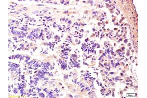 Formalin-fixed and paraffin embedded human rectal carcinoma labeled with Anti-AMPK gamma 3/PRKAG3 Polyclonal Antibody, Unconjugated (ABIN751873) at 1:200 followed by conjugation to the secondary antibody and DAB staining. (PRKAG3 antibody  (AA 151-250))