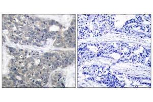 Immunohistochemical analysis of paraffin-embedded human breast carcinoma tissue using p70 S6 Kinase (phospho-Thr421) antibody (E011254). (RPS6KB1 antibody  (pThr421))