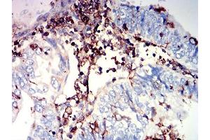 Immunohistochemical analysis of paraffin-embedded endometrial cancer tissues using CD97 mouse mAb with DAB staining. (CD97 antibody  (AA 419-552))