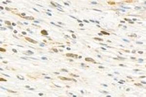 Immunohistochemistry (Paraffin-embedded Sections) (IHC (p)) image for anti-Poly (ADP-Ribose) Polymerase 1 (PARP1) (cleaved) antibody (ABIN7075114)