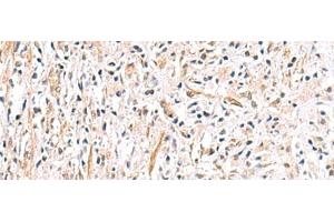 Immunohistochemistry of paraffin-embedded Human prost ate cancer tissue using HLA-DOB Polyclonal Antibody at dilution of 1:40(x200) (HLA-DOB antibody)
