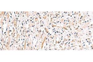 Immunohistochemistry of paraffin-embedded Human prost ate cancer tissue using HLA-DOB Polyclonal Antibody at dilution of 1:40(x200)